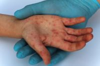 Προβληματισμός για την επιδημία ιλαράς που "δεν φαίνεται να σταματάει"