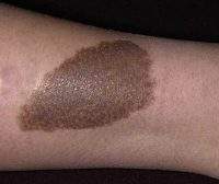 είναι-τα-εκ-γενετής-σημάδια-birthmarks-Είναι-επικίνδυνα-200x168.jpg