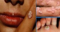 μυρμηγκιές-Human-Papillomavirus-HPV.-Πώς-μεταδίδονται-πρόληψη-και-εμβολιασμός-200x107.jpg