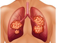 φάρμακο-το-atezolizumab-ανοσοθεραπείας-για-τον-καρκίνο-του-πνεύμονα-και-της-ουροδόχου-κύστης-200x150.jpg