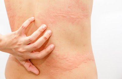 τη-χρόνια-κνίδωση-η-ομαλιζουμάμπη-της-Novartis-συνιστάται-από-τις-νέες-παγκόσμιες-κατευθυντήριες-οδηγίες.jpg