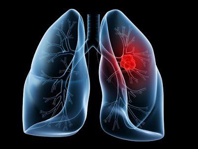 συνδυασμός-του-nivolumab-με-χαμηλή-δόση-ipilimumab-μειώνει-τον-κίνδυνο-εξέλιξης-της-νόσου-ή-θανάτου-σε-ασθενείς-με-καρκίνο-του-πνεύμονα.jpg