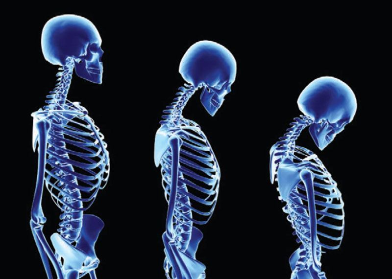 osteoporosis1
