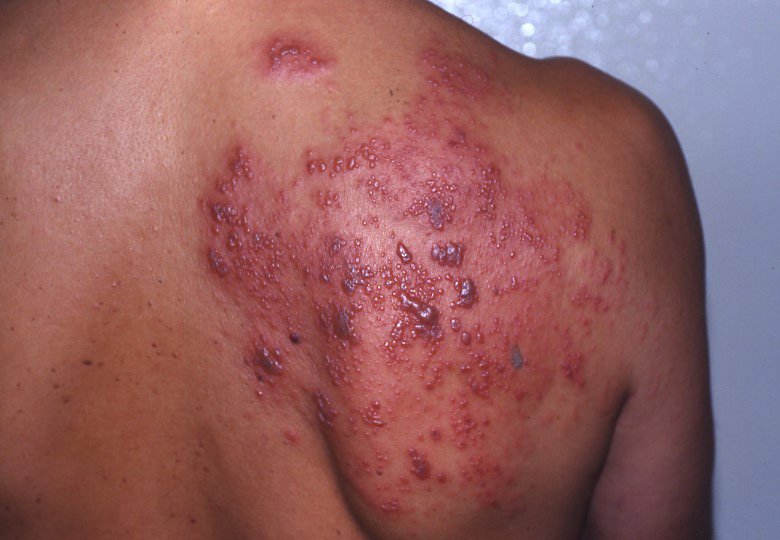 herpes.jpg